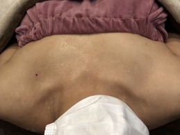 ミラクルバスト施術 40代