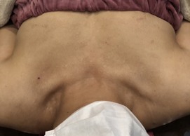 ミラクルバスト施術 40代