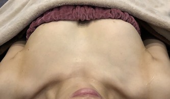 ミラクルバスト施術 30代