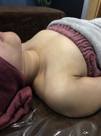 ミラクルバスト施術 20代