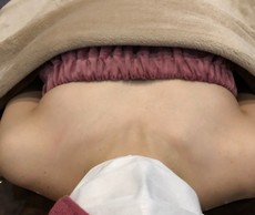 ミラクルバスト施術 20代