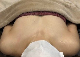 ミラクルバスト施術 20代