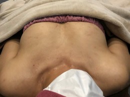 ミラクルバスト施術 40代 リピーター様