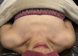 ミラクルバスト施術 40代