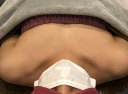ミラクルバスト施術 20代