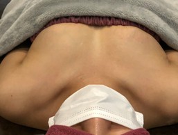 ミラクルバスト施術 20代