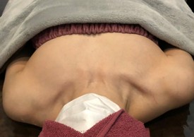 ミラクルバスト施術 40代