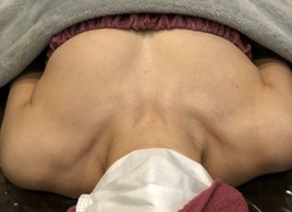 ミラクルバスト施術 40代