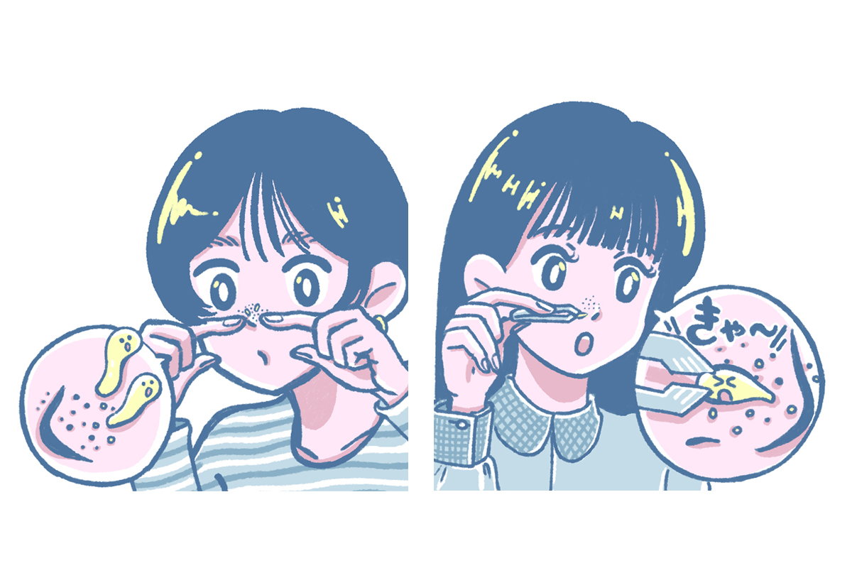♡角栓はピンセットで除去していいの？♡