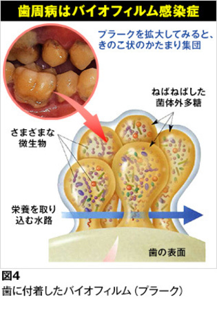 歯周病とはどんな病気ですか