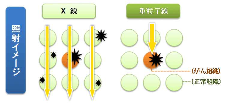 受講講座の紹介「がん重粒子線治療」